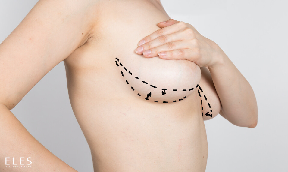 Kỹ thuật cắt ngực Double Incision